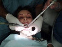 Dantų balinimo procedūra