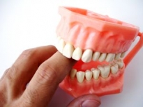 Dantų implantų rūšys