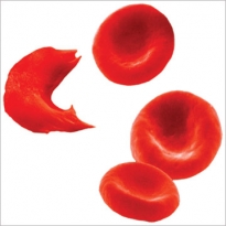 Kas yra pjautuvo formos kūnelių anemija?